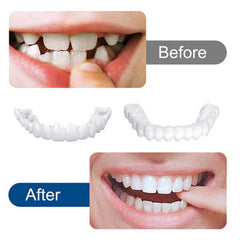 SnapOn Smile Dental Veneers | 100% Recommended for everyone